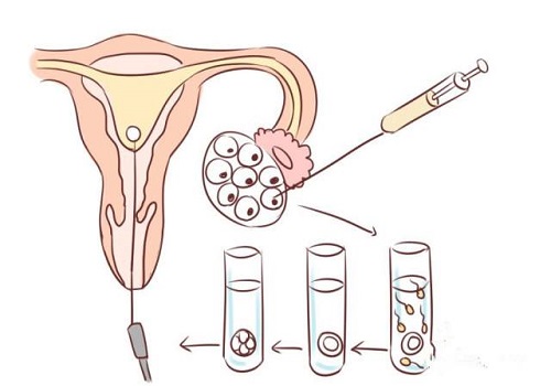 试管婴儿药物对女性的伤害大吗？会诱发肿瘤吗？