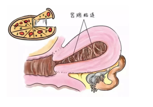 美国试管婴儿费用及流程？